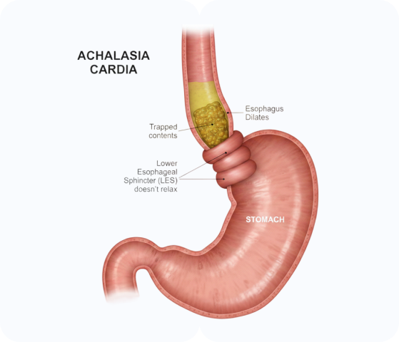 Achalasia Cardia Surgery