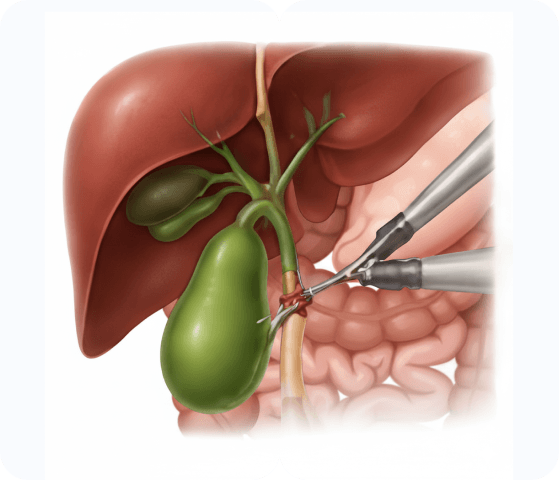 Gallstone Formation