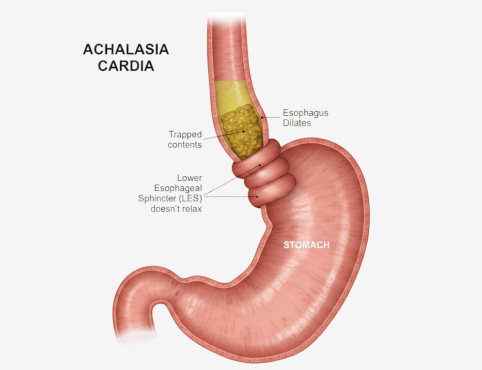 Achalasia Cardia