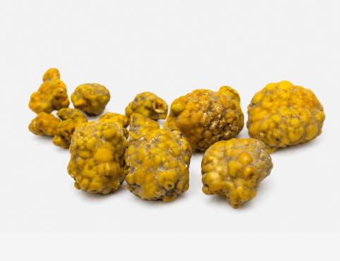 Cholesterol Stones