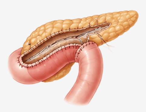 Chronic Pancreatitis