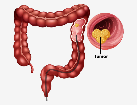 Colon Cancer