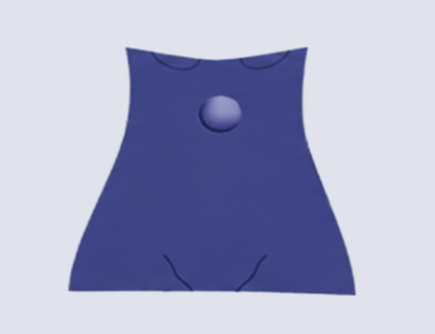 Epigastric Hernia