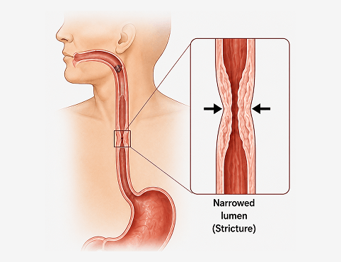 Esophageal Stricture