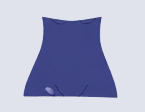 Femoral Hernia