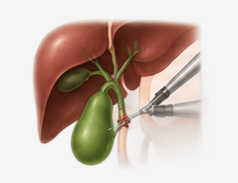 Gallbladder Stone Surgery