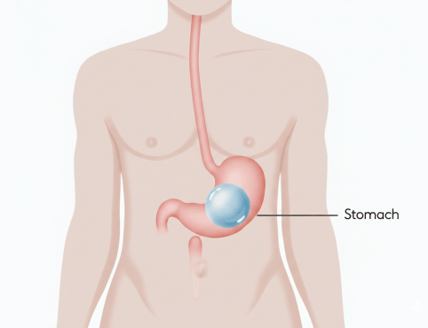 Gastric Balloon