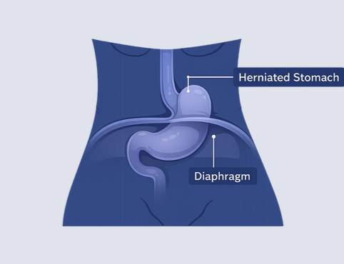 Hiatus Hernia