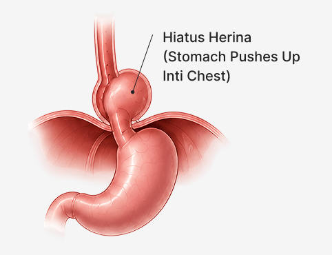 Hiatus Hernia