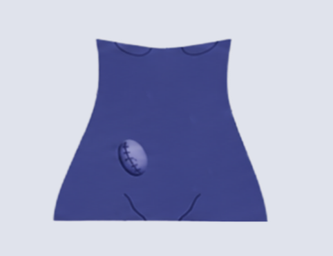 Incisional Hernia