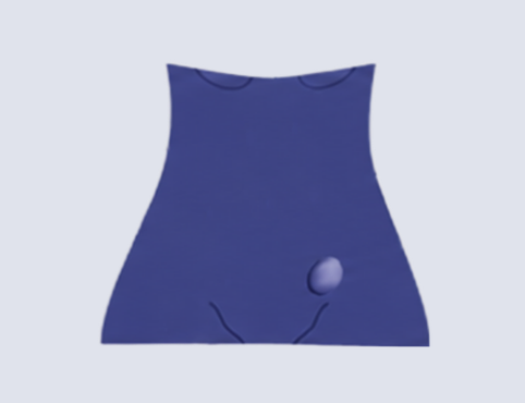 Inguinal Hernia