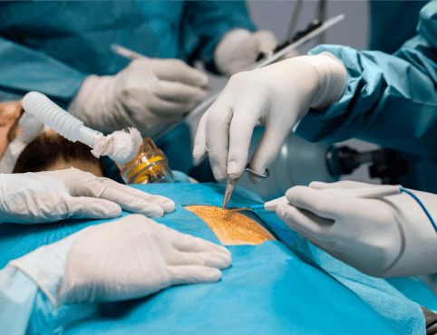 Open Hernia Surgery
