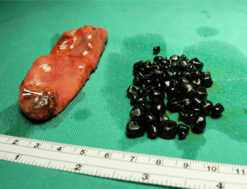 Pigment Stones