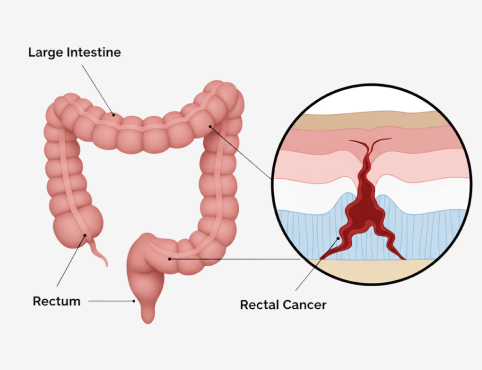 Rectal Cancer