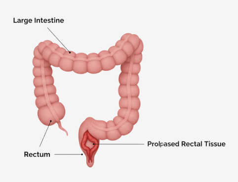 Rectal Prolapse