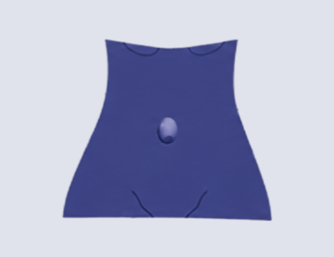 Umbilical Hernia